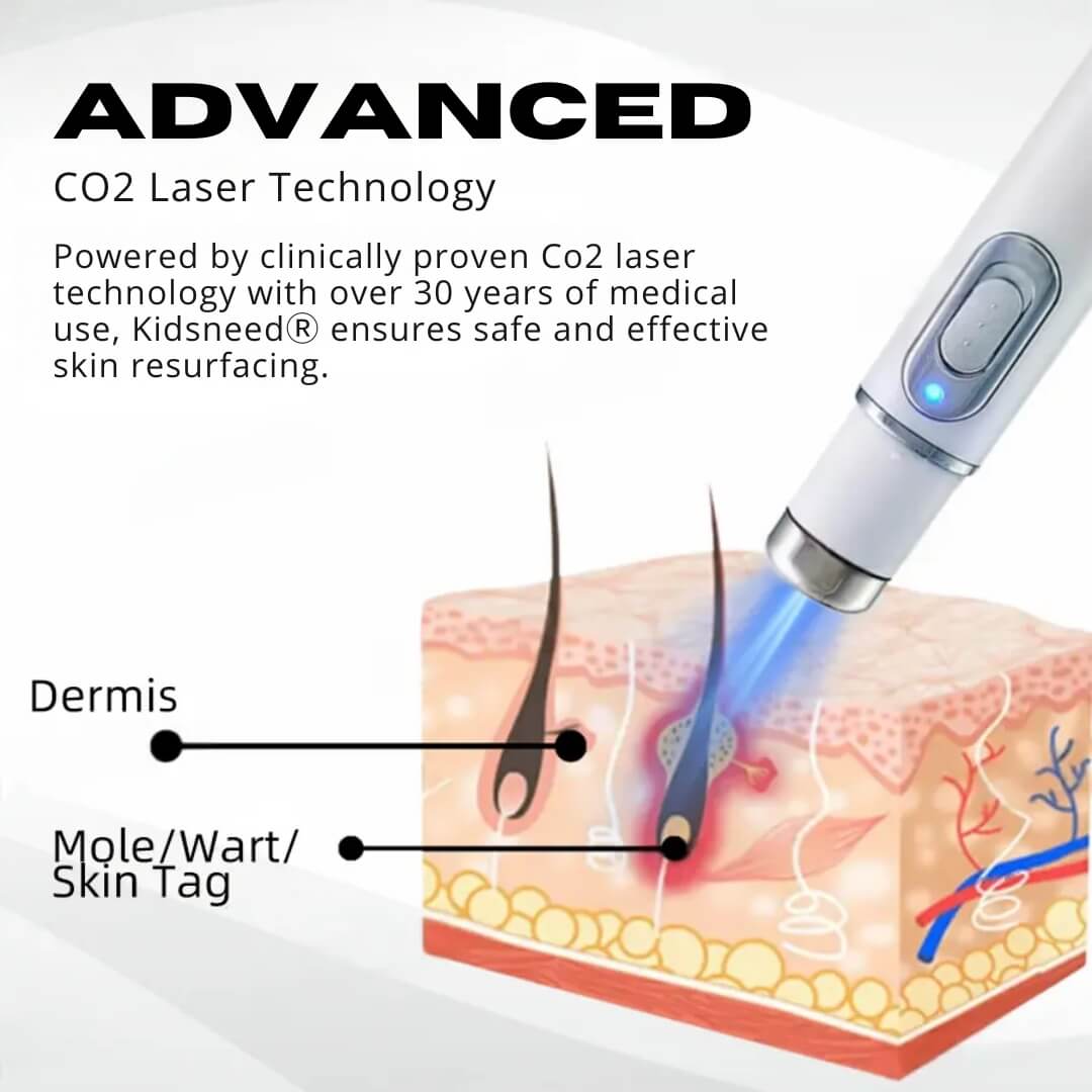 Kidsneed® - Mole and Wart Removal Laser Pen