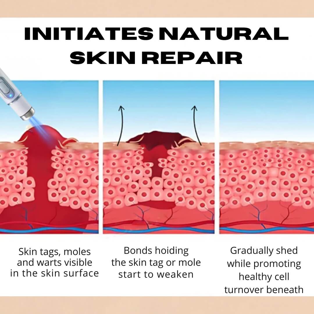 Kidsneed® - Mole and Wart Removal Laser Pen